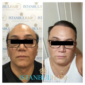 trapianto capelli turchia prima dopo