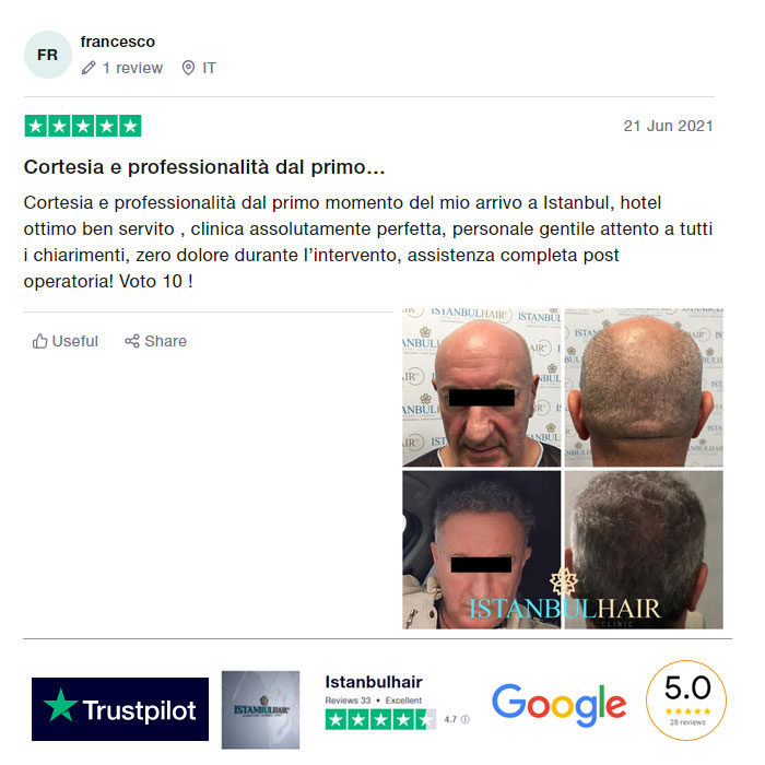 Trapianto Capelli Turchia recensioni